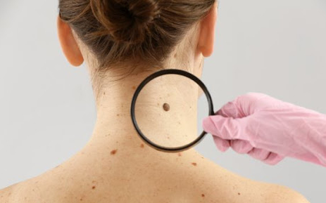 Új módszer forradalmasíthatja a bőrrák diagnosztizálását