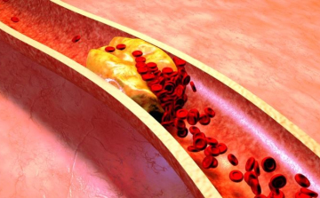 A mélyvénás trombózis jelei