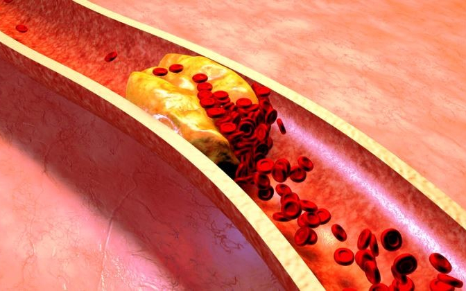 A mélyvénás trombózis jelei